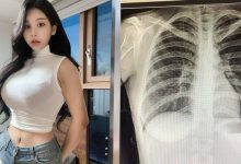 [网络美女]韩国「百万网红」不满被质疑整形…晒X光照自证清白：我没有动过手术-德州扑克迷