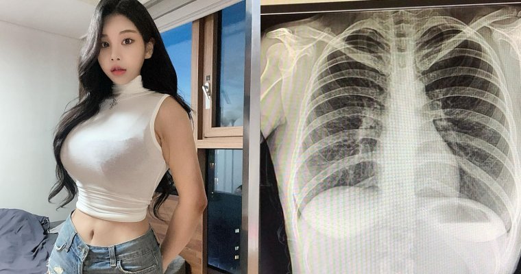 [网络美女]韩国「百万网红」不满被质疑整形…晒X光照自证清白：我没有动过手术