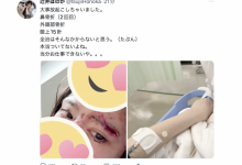 鼻子骨折眼皮缝了15针！辻井ほのか(辻井穗乃果)重伤破相！-德州扑克迷