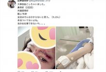 鼻子骨折眼皮缝了15针！辻井ほのか(辻井穗乃果)重伤破相！-德州扑克迷