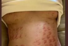 除毛搞得一身伤！宝生リリー(宝生莉莉)恐生涯终结！【EV扑克下载】-德州扑克迷