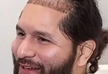 从八角笼到手术台：UFC名将豪尔赫·马斯维达尔赴土耳其植发，大发体育助力你的致富之路！-德州扑克迷